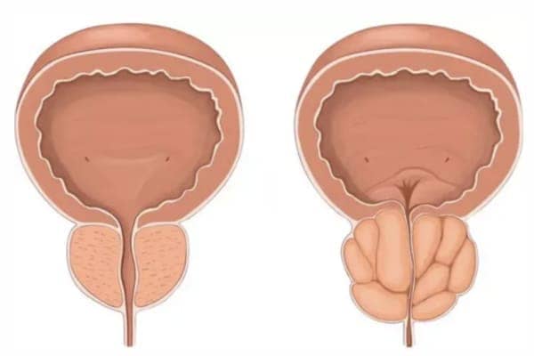 Hiperplasia de próstata